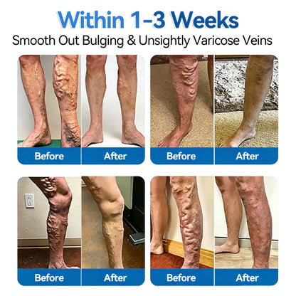 🌼💖𝐅𝐥𝐨𝐫𝐢𝐬𝐦𝐚® 𝐕𝐞𝐢𝐧𝐑𝐞𝐩𝐚𝐢𝐫 𝐌𝐢𝐜𝐫𝐨𝐧𝐞𝐞𝐝𝐥𝐞 𝐏𝐚𝐭𝐜𝐡 𝐑𝐨𝐥𝐥⚡Instant Relief, Long-Term Results