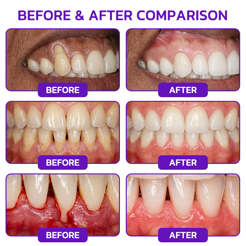 🎁GLIMMERLY® VioCore Bee Venom Gingivitis & Periodontitis Treatment Toothpaste（副本）