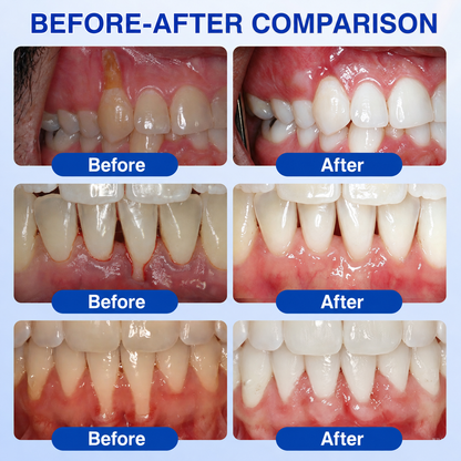 🦷𝑮𝒍𝒊𝒎𝒎𝒆𝒓𝒍𝒚® 𝑮𝒖𝒎𝑹𝒆𝒗𝒊𝒗𝒆 𝑷𝒆𝒓𝒊𝒐𝒅𝒐𝒏𝒕𝒂𝒍 𝑹𝒆𝒑𝒂𝒊𝒓 𝑮𝒆𝒍