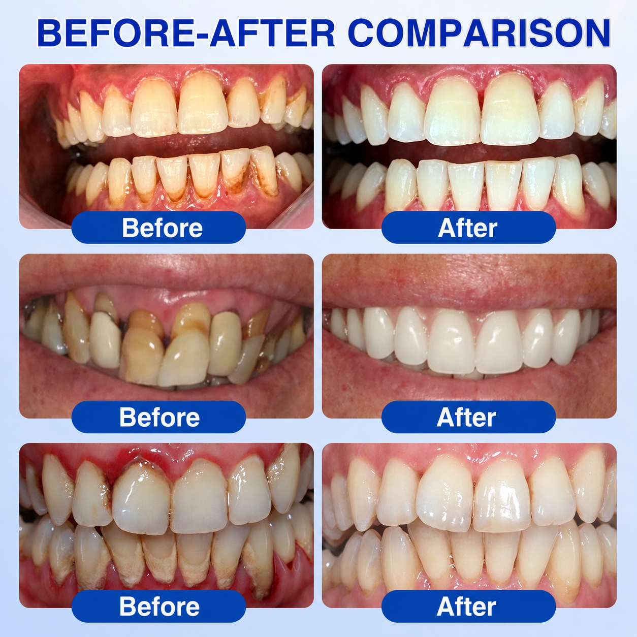 🦷𝑮𝒍𝒊𝒎𝒎𝒆𝒓𝒍𝒚® 𝑮𝒖𝒎𝑹𝒆𝒗𝒊𝒗𝒆 𝑷𝒆𝒓𝒊𝒐𝒅𝒐𝒏𝒕𝒂𝒍 𝑹𝒆𝒑𝒂𝒊𝒓 𝑮𝒆𝒍