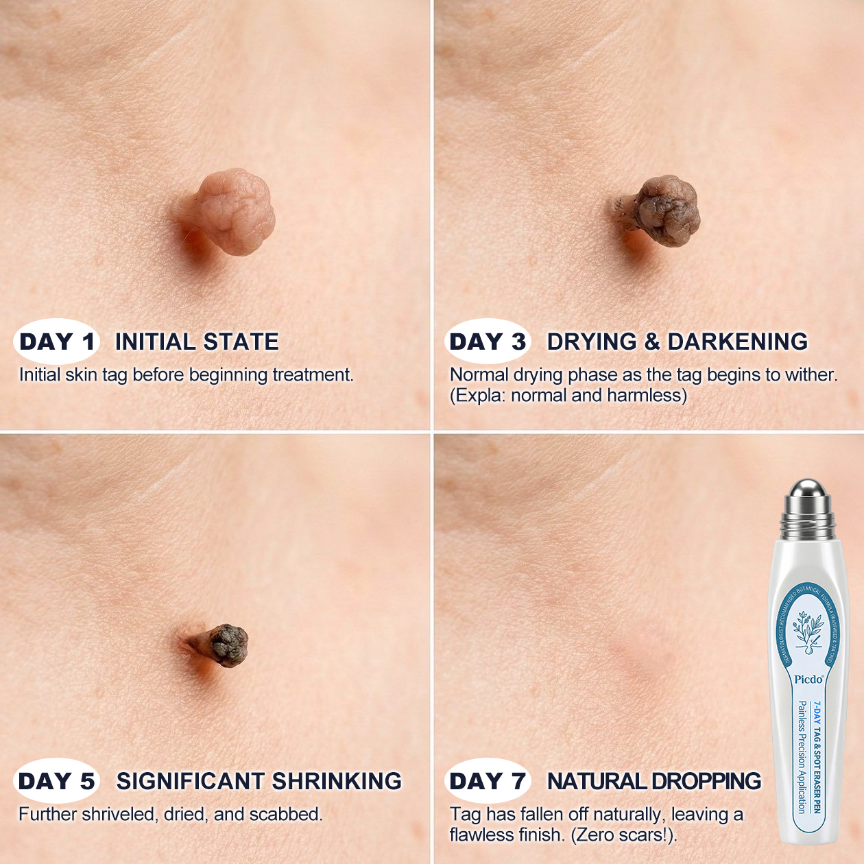 𝐏i𝐜𝐝o® 🪻💖7-𝐷𝑎𝑦 𝗧𝐚𝐠 & 𝗦𝗽𝐨𝐭 𝐄𝐫𝒂𝒔𝒆𝒓(Zero Pain, Zero 𝐒𝐜𝐚𝒓𝒔 Rollerball)