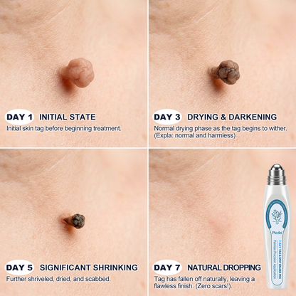 𝐏i𝐜𝐝o® 🪻💖7-𝐷𝑎𝑦 𝗧𝐚𝐠 & 𝗦𝗽𝐨𝐭 𝐄𝐫𝒂𝒔𝒆𝒓(Zero Pain, Zero 𝐒𝐜𝐚𝒓𝒔 Rollerball)